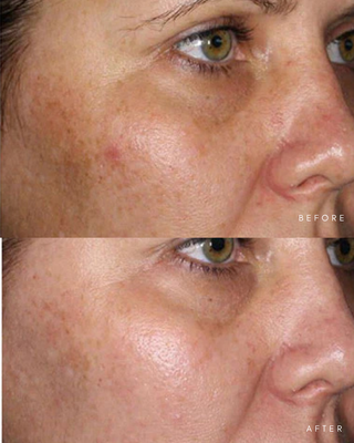 Pigmentation Bundle