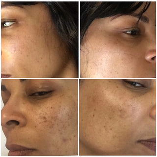 CO2 Carboxy Gel Lift Pro