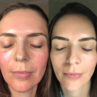 CO2 Carboxy Gel Lift Pro