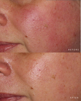 Rosacea Bundle
