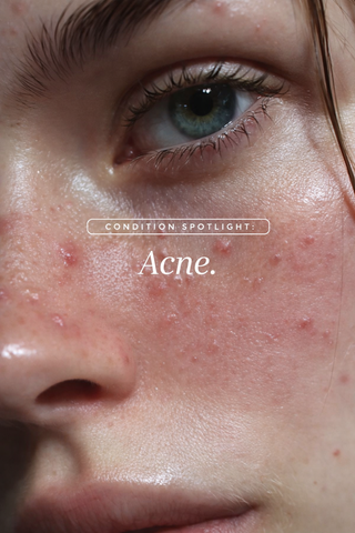 Acne Bundle