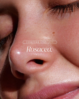 Rosacea Bundle